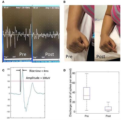 Are There Trigger Points in the Spastic Muscles? Electromyographical Evidence of Dry Needling Effects on Spastic Finger Flexors in Chronic Stroke